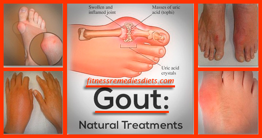 How To Treat Gout? Treatment For Gout With Home Remedies For Gout 