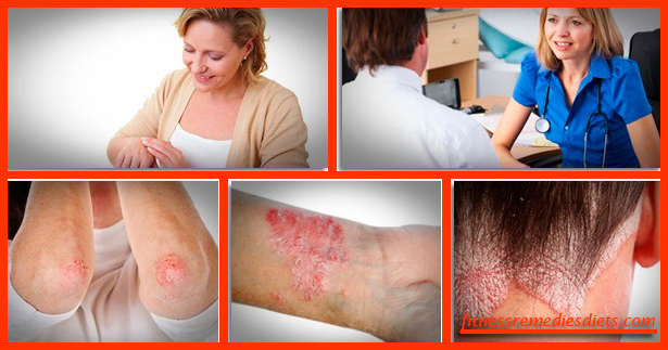 how to cure psoriasis