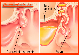 polyps in nose