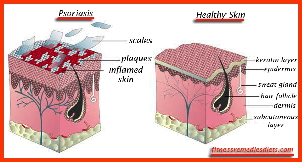 how to get rid of psoriasis