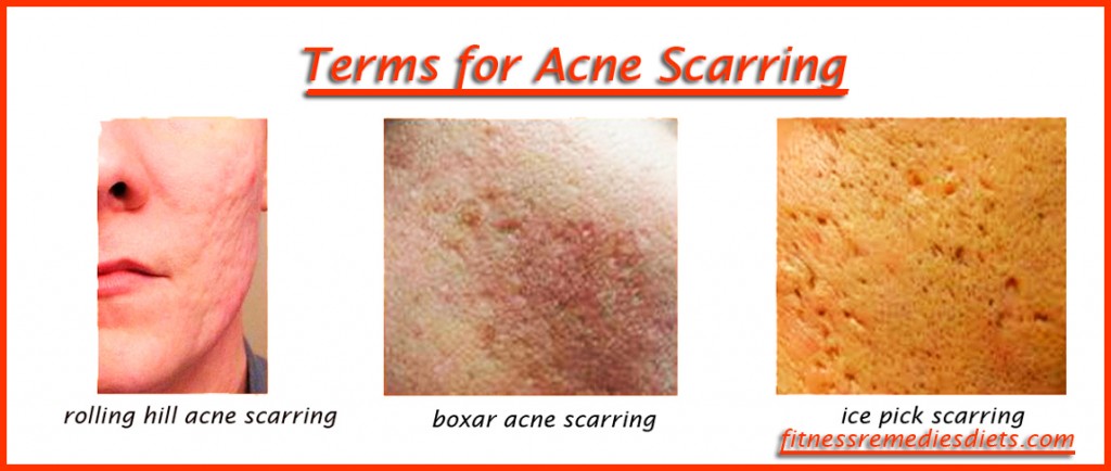 terms for acne scars