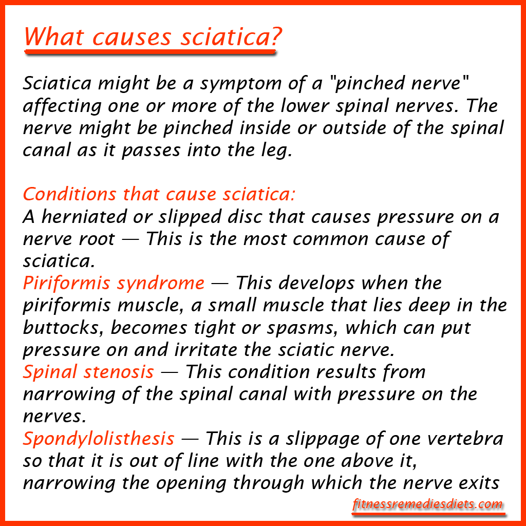 what causes sciatica