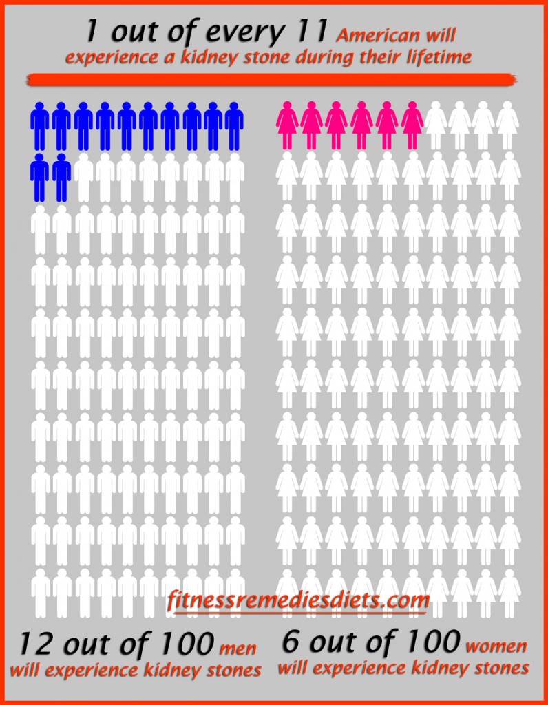 how common are kidney stones 1