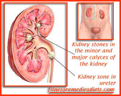 kidney stones in ureter