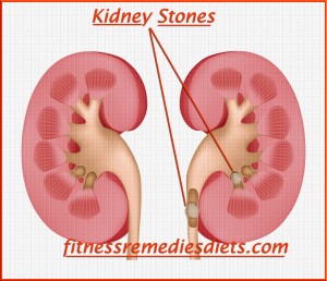 kidney stones picture